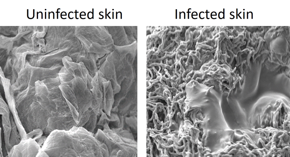 Photo showing comparison of infected and uninfected skin